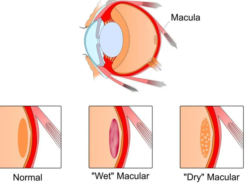 Illustration of the loss of central vision in people with AMD