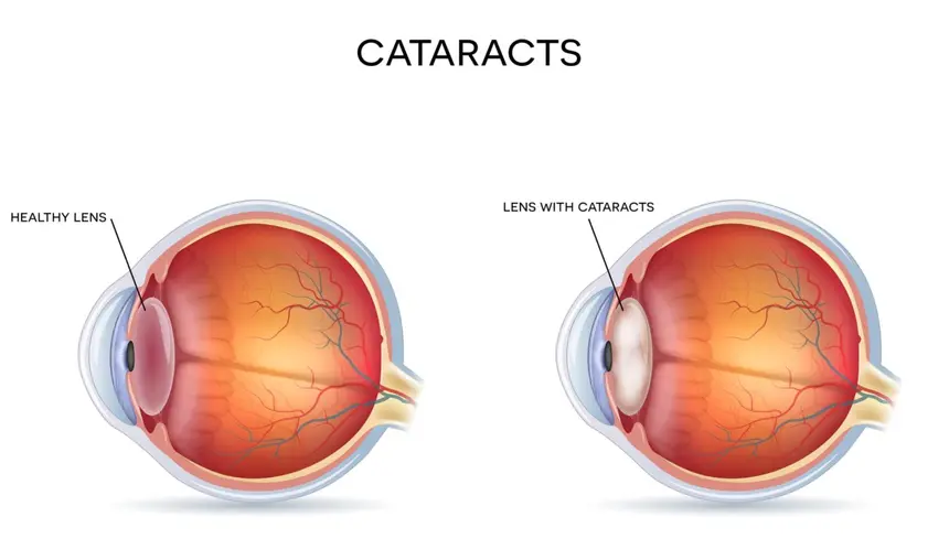 Anatomy of the eye with and without cataracts