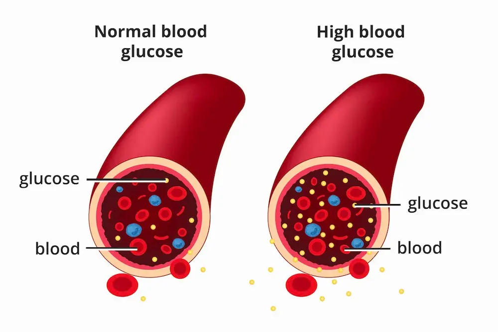 Figure 1 : Illustration of the excessive rise in blood glucose levels.